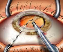 Phacoemulsification